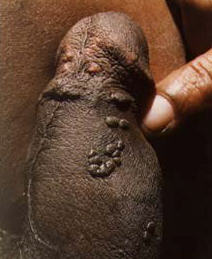 Genital warts on the side of the penis