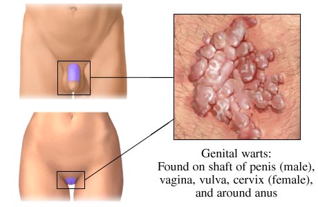 Genital Warts on men and women