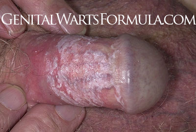 Male yeast infection up and down the shaft area of the penis