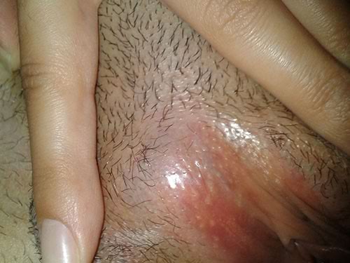 female fordyce bumps