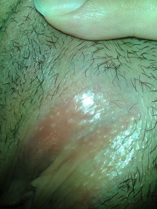 female fordyce bumps