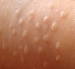 fordyce spots close up