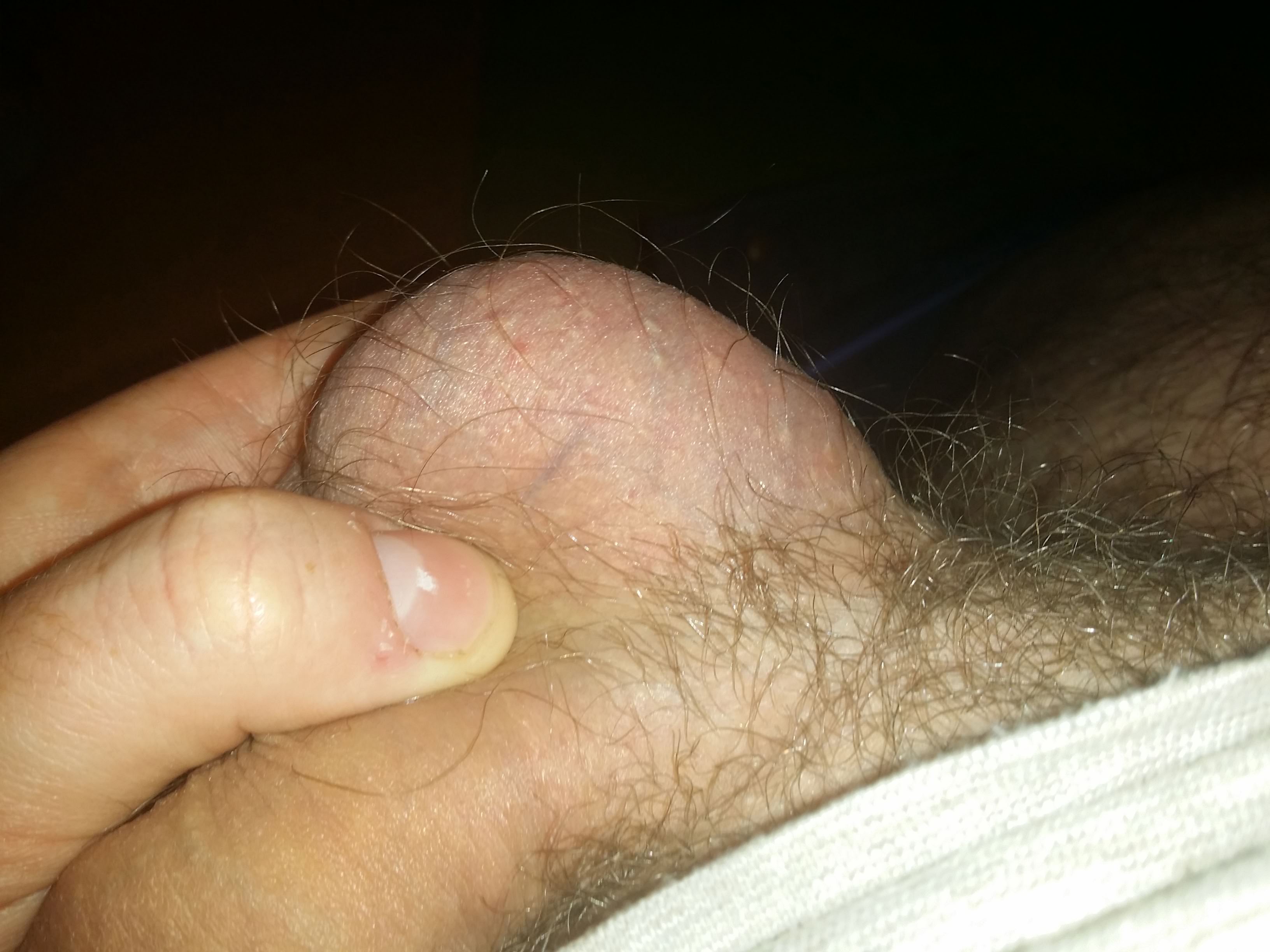 fordyce spots on the balls