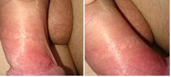 fordyce on the scrotum area and a ring of white blotches around the shaft