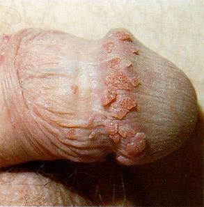 genital warts grouped around the rim of penis head