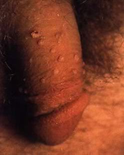 spread out group of warts on mans shaft
