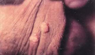 clusters of warts on mans foreskin