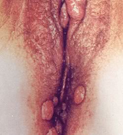 flat disc shaped genital warts on a woman
