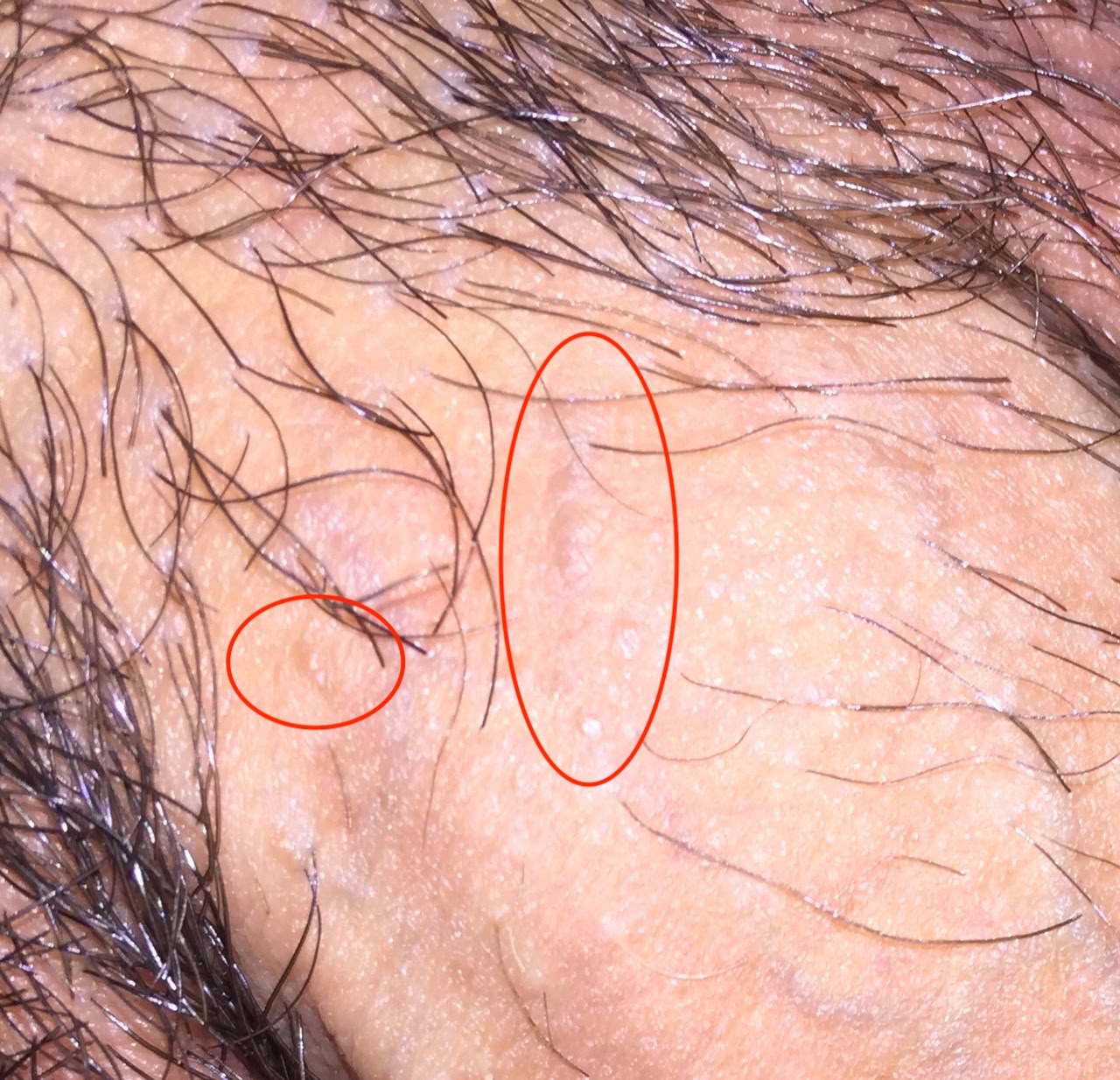 skin colored warts on penis shaft