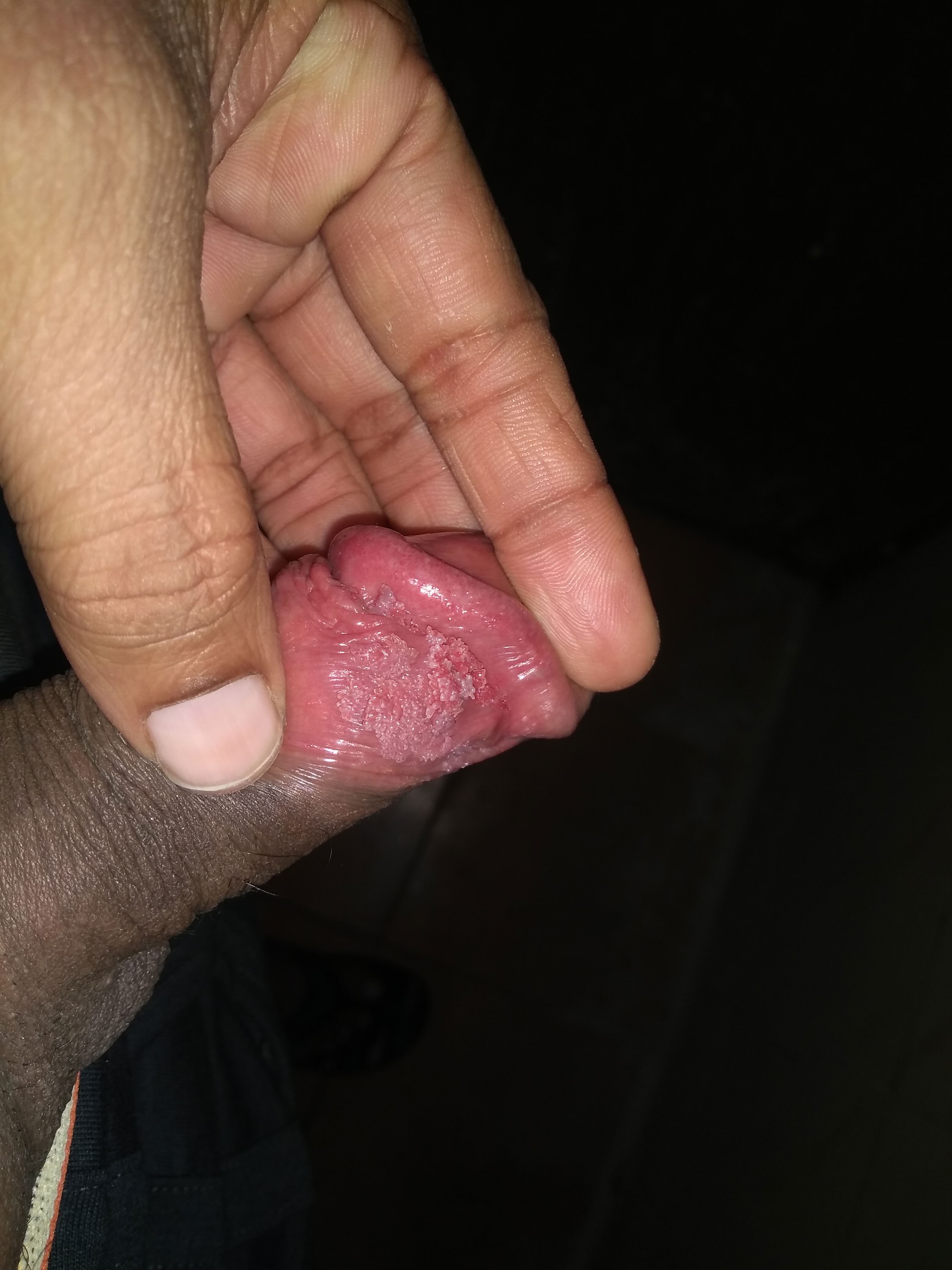 really bad case of warts under the penis head