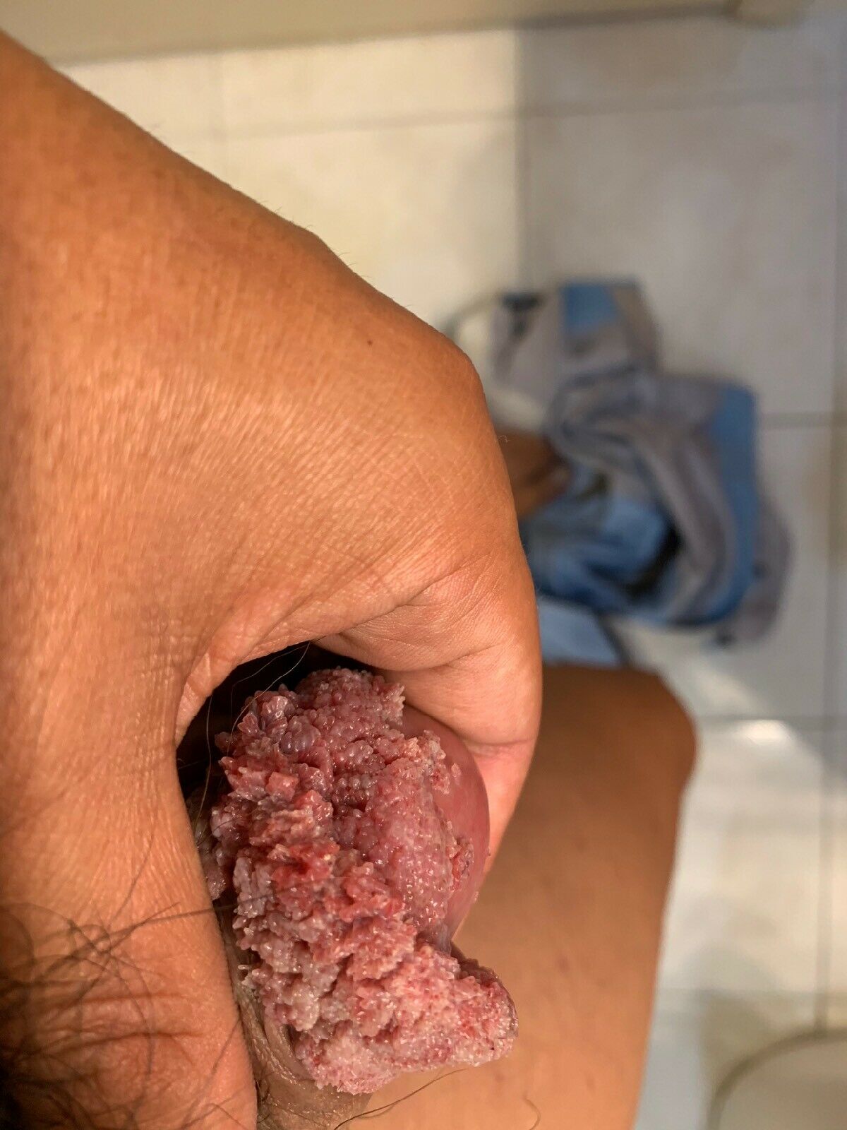 crystal-like genital warts formation