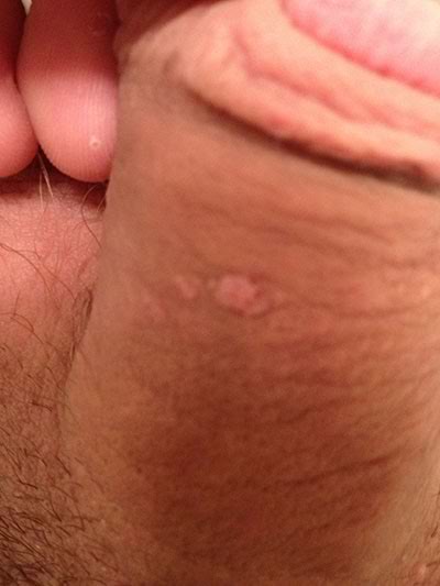 small skin colored genital warts